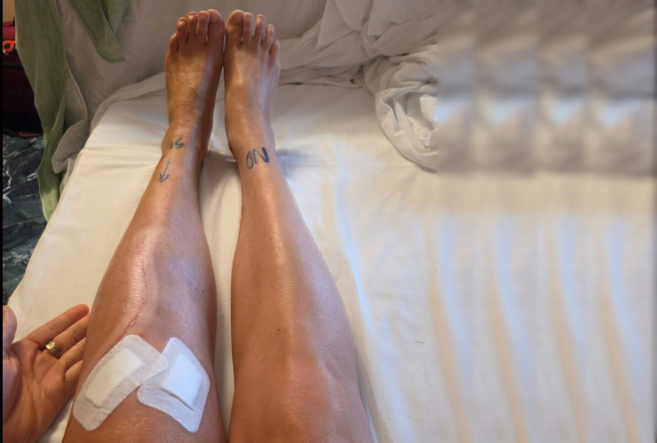 Le gambe di Federica Brignone dopo l'operazione